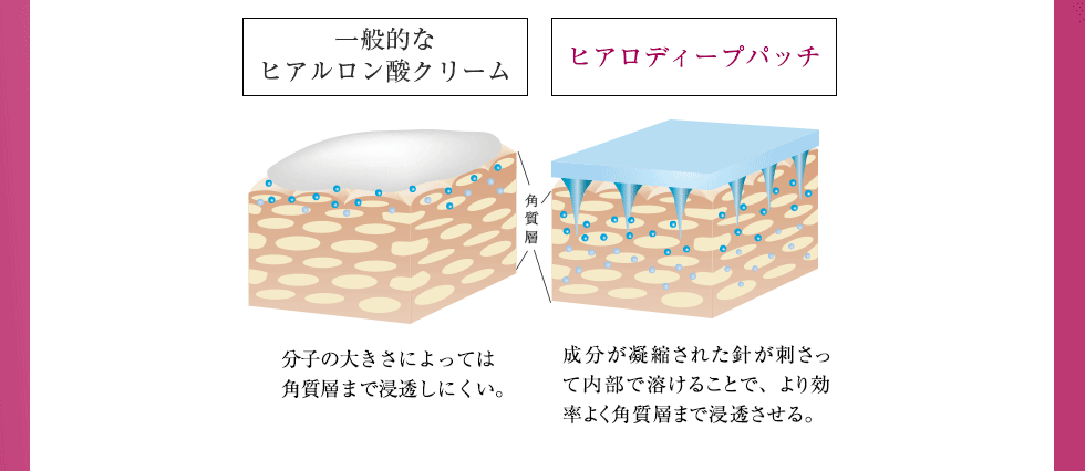 一般的なヒアルロン酸クリームは分子の大きさによっては角質層まで浸透しにくい。ヒアロディープパッチは美容成分が凝縮された針が刺さって内部で溶けることで、より効率よく角質層まで浸透させる。